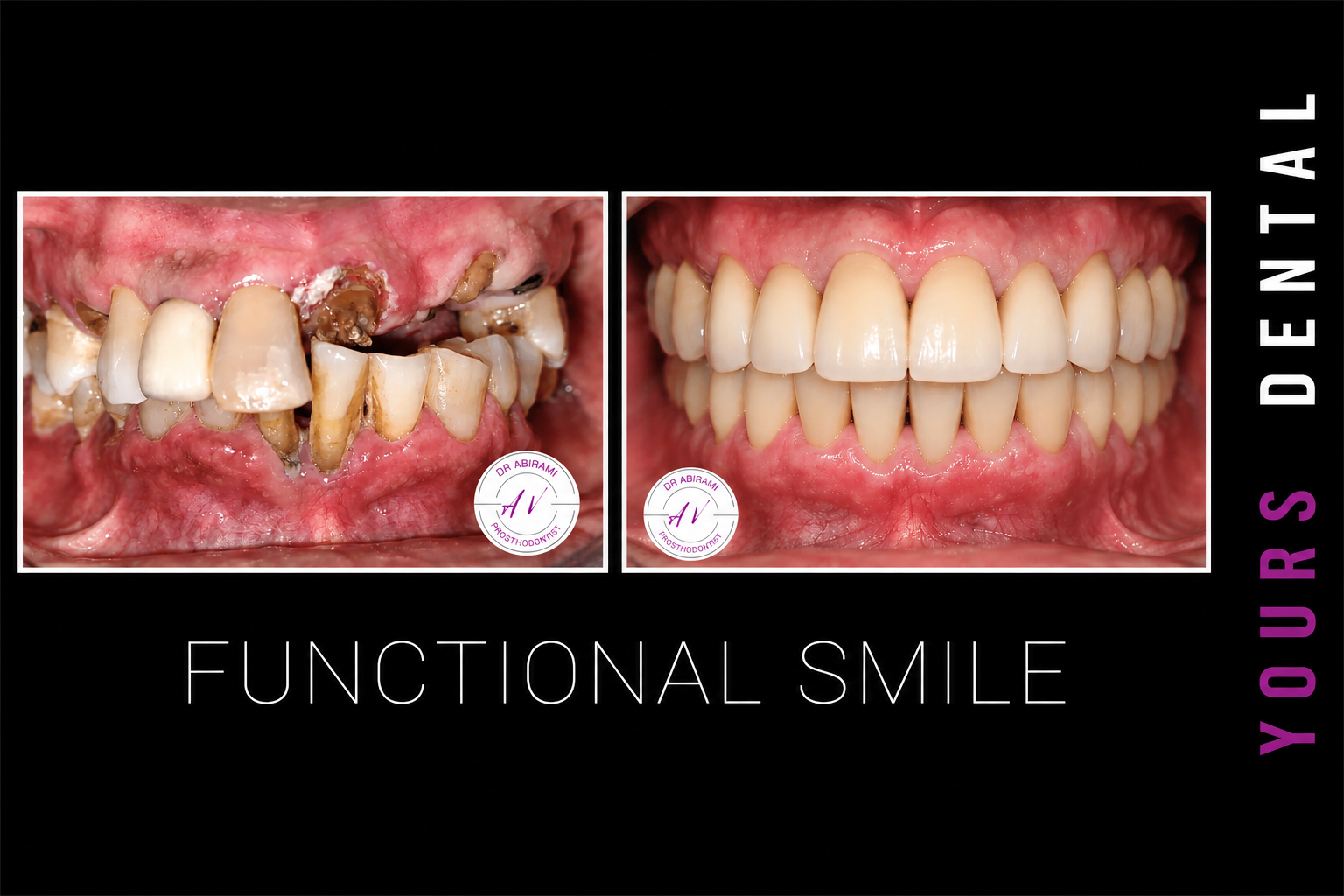 Dental Crowns & Bridges